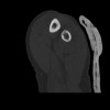 SPORK, NICO - 22.03.1976 - 02.08.2022 - CT obere Extremität - 18:01:28